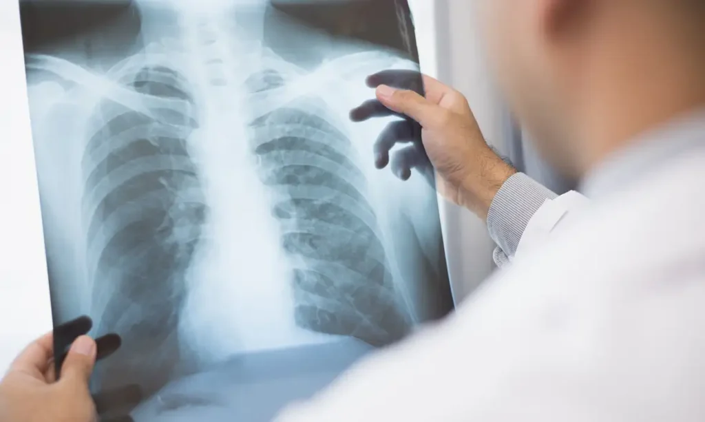 Anvisa aprova novos tratamentos avançados para câncer de pulmão e de mama